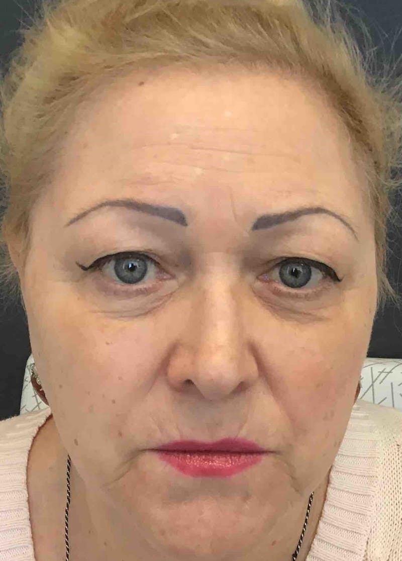Dermal Fillers Before & After Gallery - Patient 100588 - Image 2