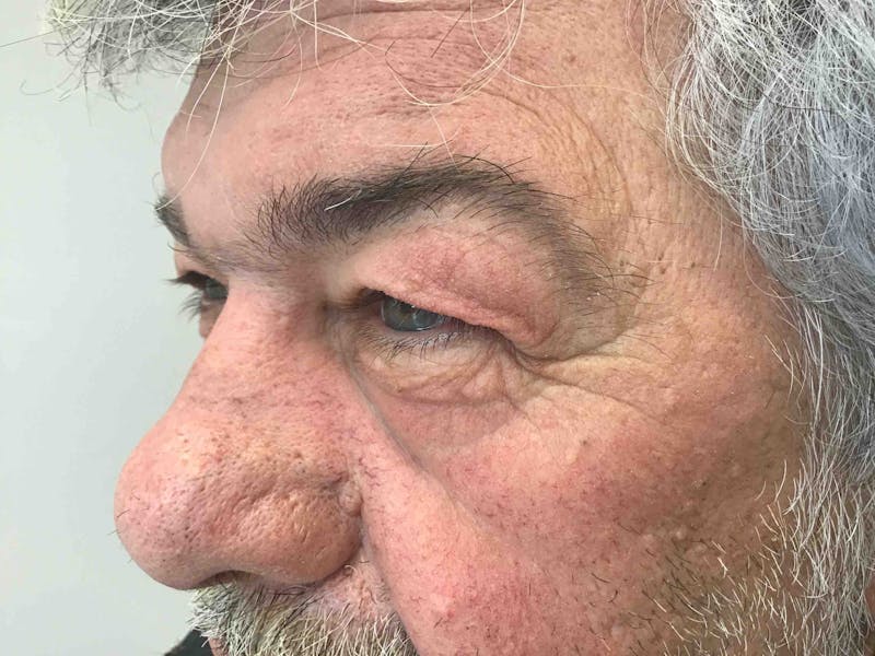 Blepharoplasty Before & After Gallery - Patient 254621 - Image 3