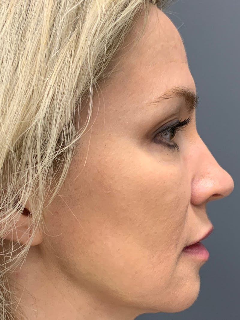 Dermal Fillers Before & After Gallery - Patient 402126 - Image 8