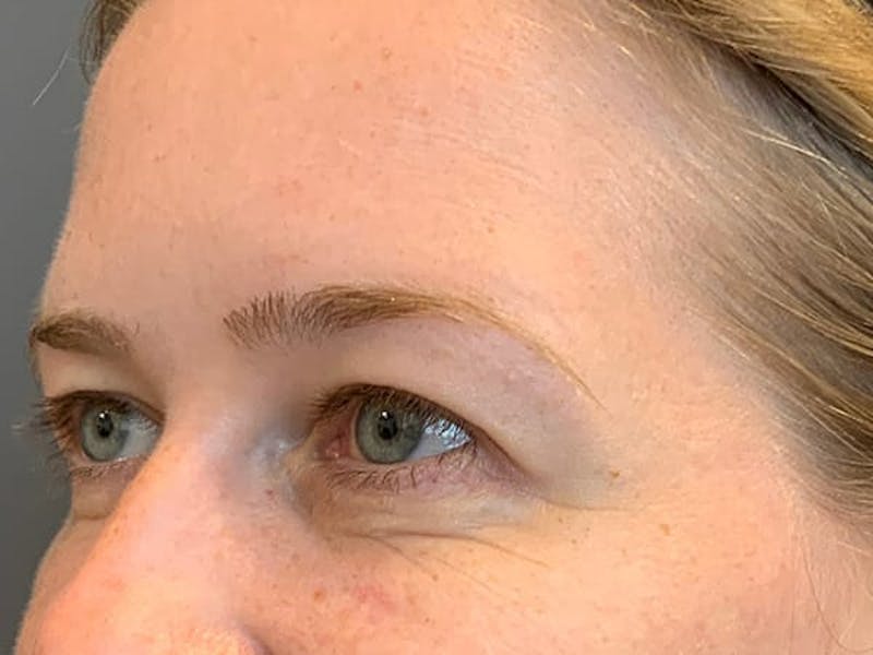 Botox Before & After Gallery - Patient 945116 - Image 9