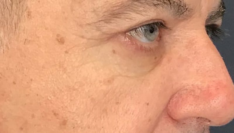 Blepharoplasty Before & After Gallery - Patient 380770 - Image 6