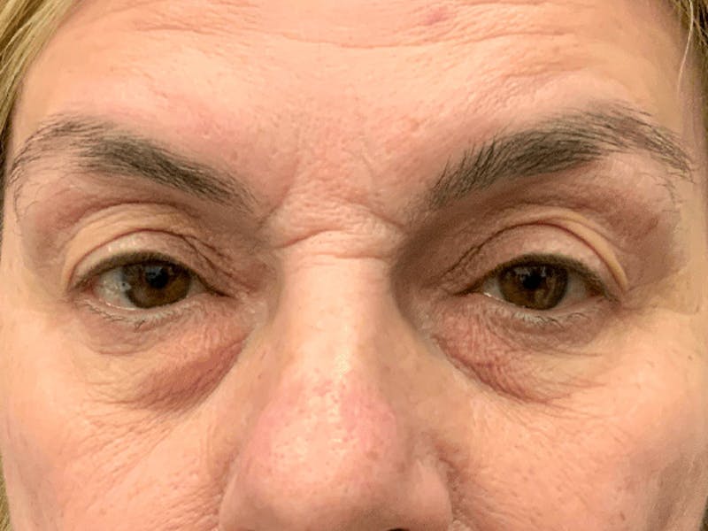 Blepharoplasty Before & After Gallery - Patient 296391 - Image 1