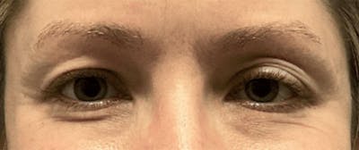 Blepharoplasty Before & After Gallery - Patient 732744 - Image 1