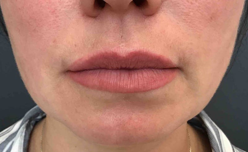Botox Before & After Gallery - Patient 174355 - Image 1