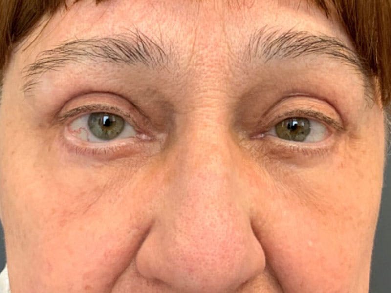 Blepharoplasty Before & After Gallery - Patient 187830 - Image 4