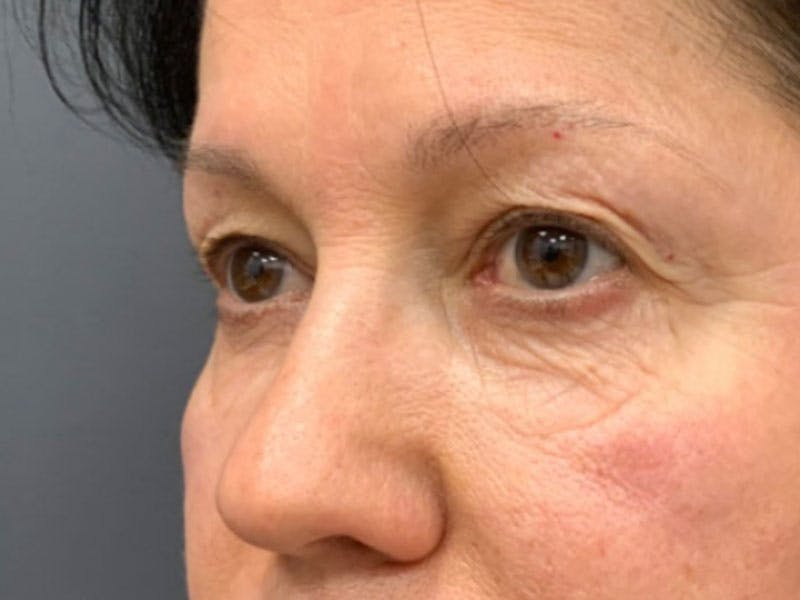 Blepharoplasty Before & After Gallery - Patient 289139 - Image 5