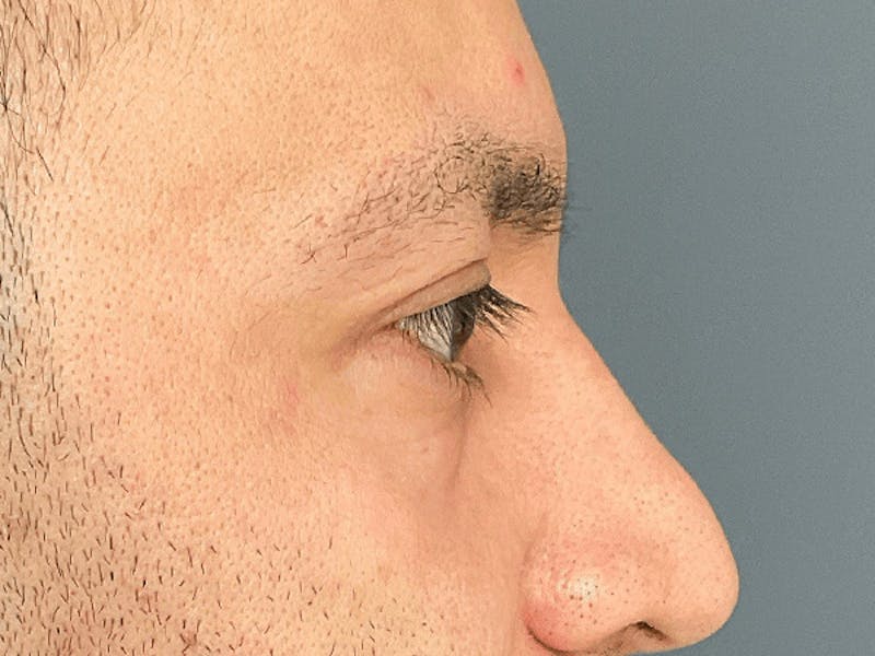 Blepharoplasty Before & After Gallery - Patient 278046 - Image 8