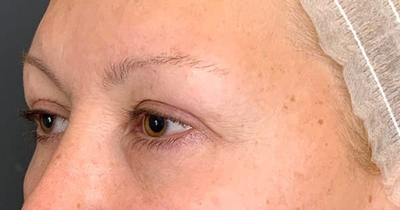 Botox Before & After Gallery - Patient 230320 - Image 4