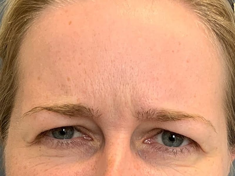 Botox Before & After Gallery - Patient 945116 - Image 1