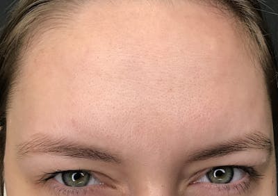 Botox Before & After Gallery - Patient 381345 - Image 2