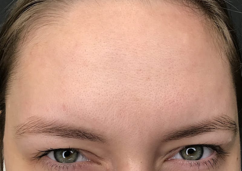 Botox Before & After Gallery - Patient 381345 - Image 2