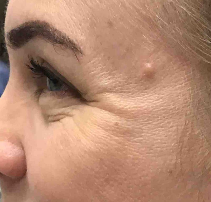 Botox Before & After Gallery - Patient 362280 - Image 1