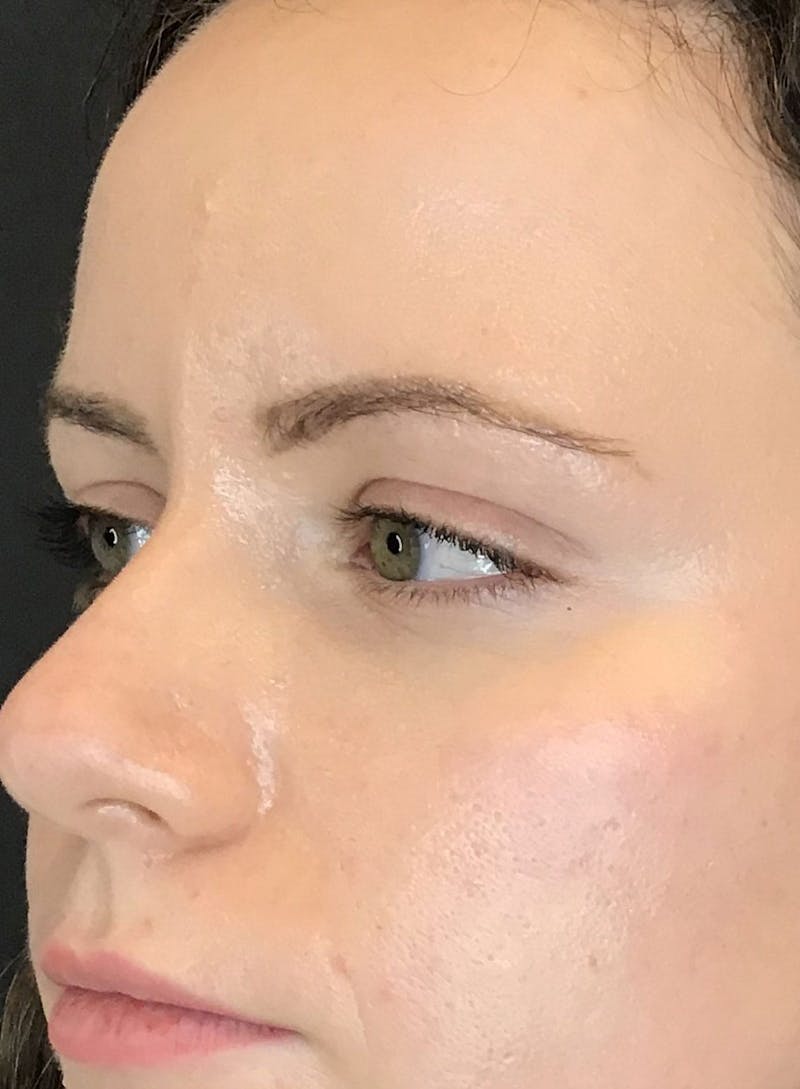 Dermal Fillers Before & After Gallery - Patient 210414 - Image 4