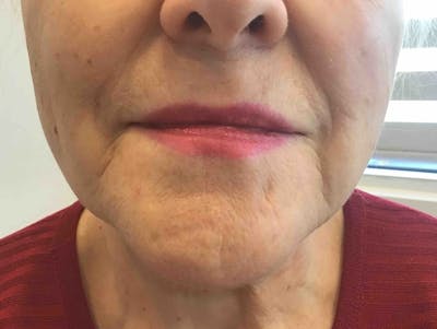 Dermal Fillers Before & After Gallery - Patient 176015 - Image 1