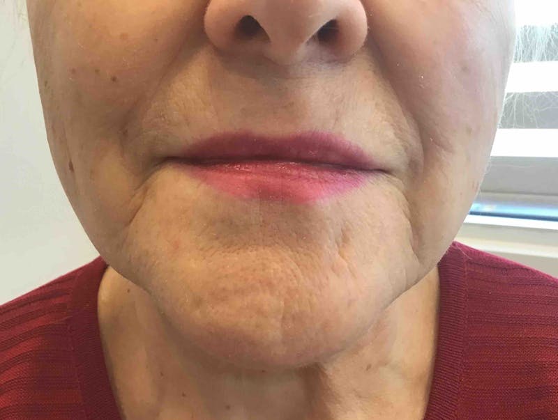 Dermal Fillers Before & After Gallery - Patient 176015 - Image 1