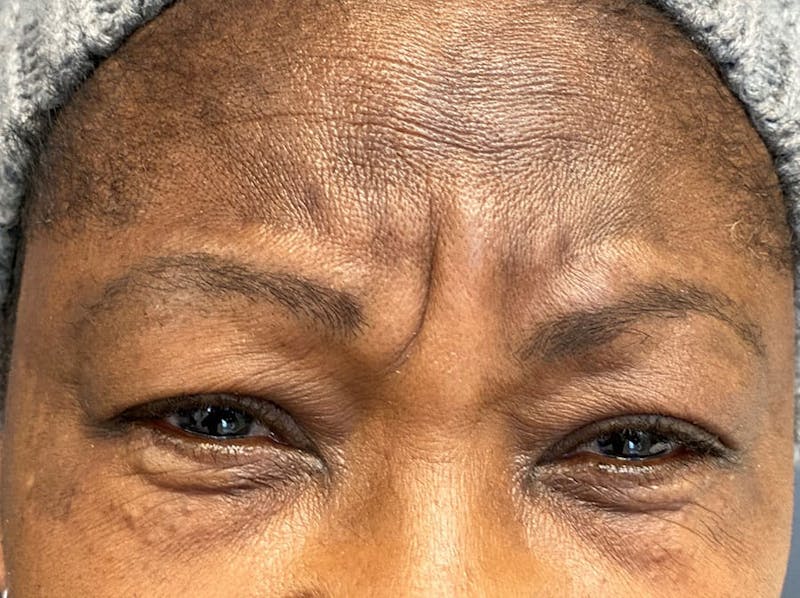 Botox Before & After Gallery - Patient 303794 - Image 1