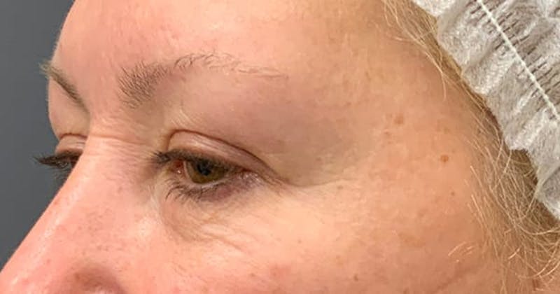 Botox Before & After Gallery - Patient 230320 - Image 3