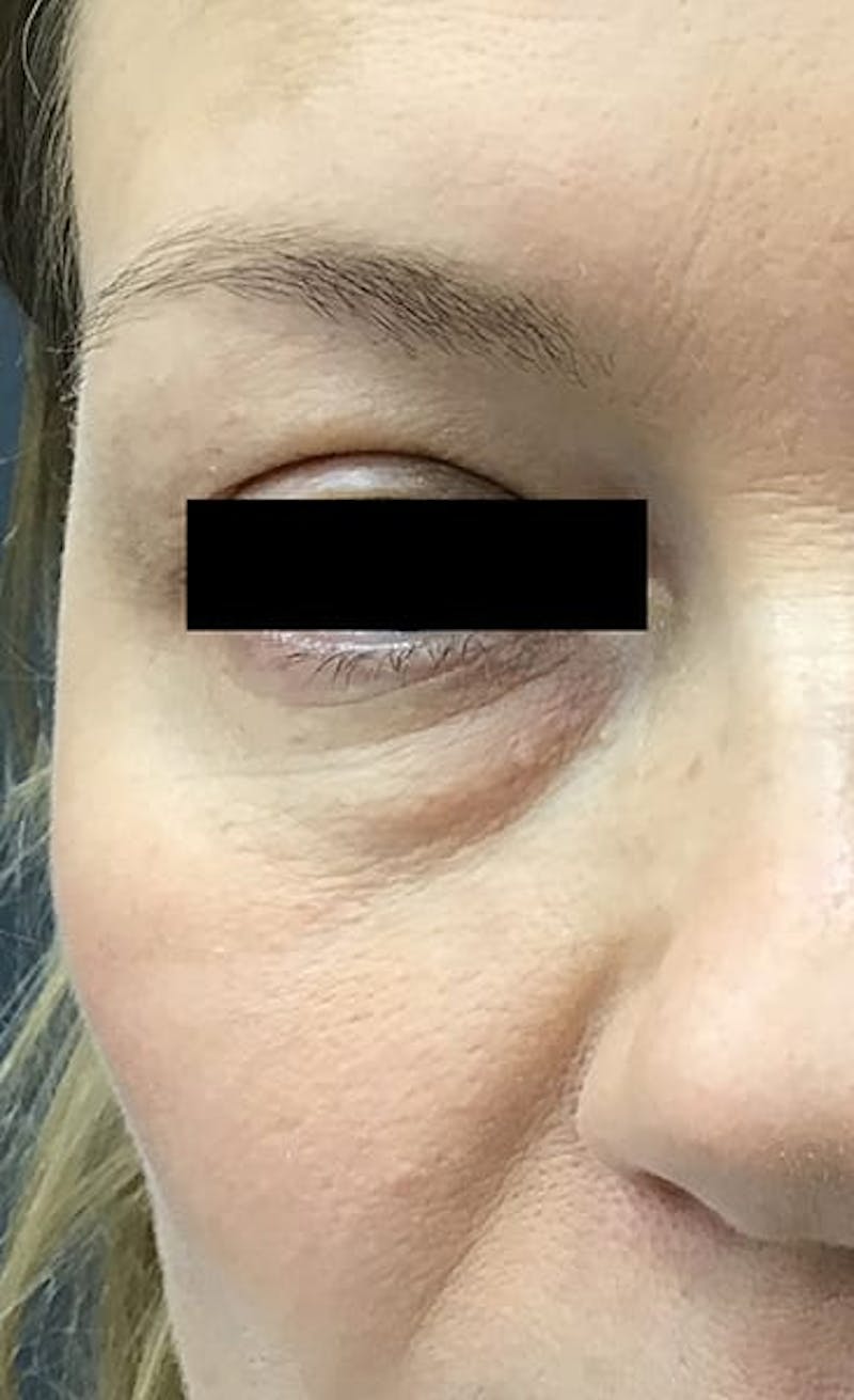 Blepharoplasty Before & After Gallery - Patient 328115 - Image 3