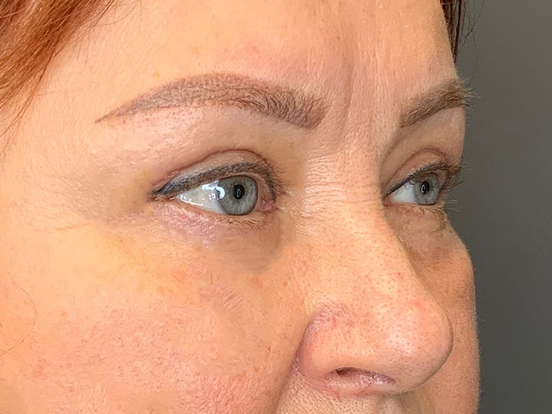 Blepharoplasty Before & After Gallery - Patient 269491 - Image 6