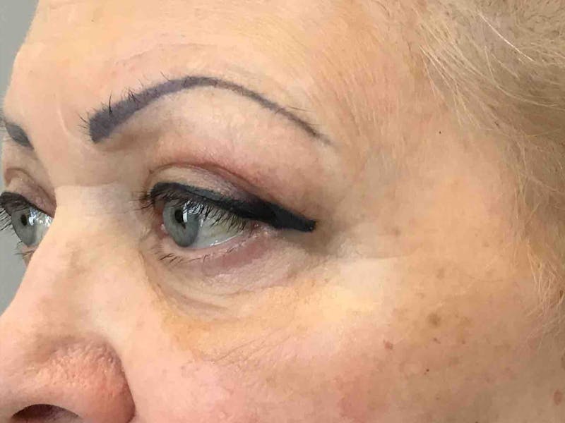 Blepharoplasty Before & After Gallery - Patient 167440 - Image 1