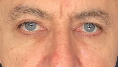 Blepharoplasty Before & After Gallery - Patient 380770 - Image 2