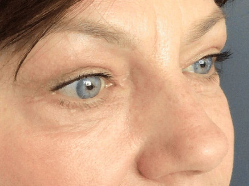 Blepharoplasty Before & After Gallery - Patient 121107 - Image 6