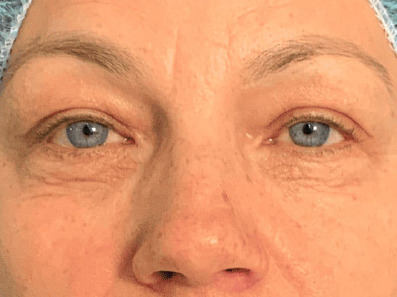 Blepharoplasty Before & After Gallery - Patient 121107 - Image 1