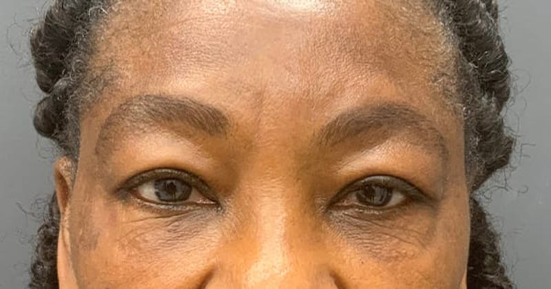 Botox Before & After Gallery - Patient 397739 - Image 2