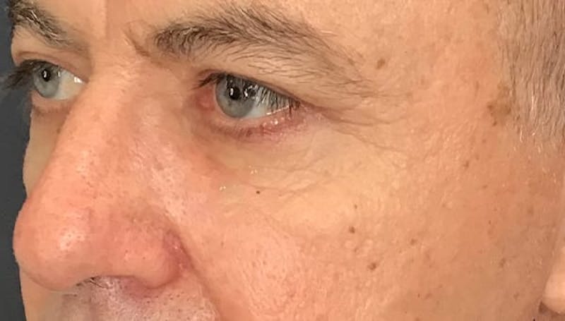 Blepharoplasty Before & After Gallery - Patient 380770 - Image 4
