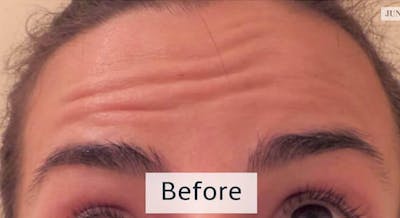Botox Before & After Gallery - Patient 349850 - Image 1