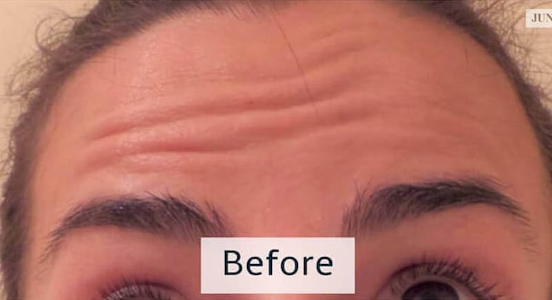 Botox Before & After Gallery - Patient 349850 - Image 1