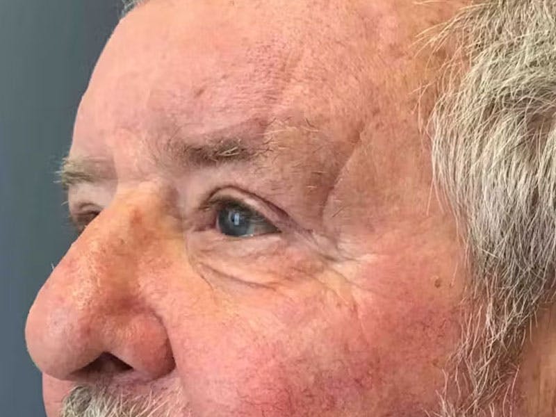 Blepharoplasty Before & After Gallery - Patient 286607 - Image 6