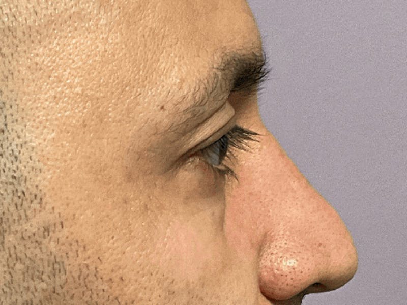 Blepharoplasty Before & After Gallery - Patient 278046 - Image 7