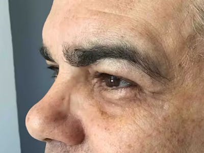 Blepharoplasty Before & After Gallery - Patient 101370 - Image 1