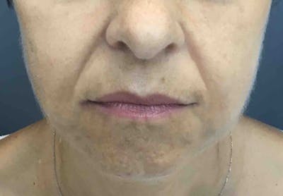 Dermal Fillers Before & After Gallery - Patient 200682 - Image 2