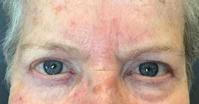 Botox Before & After Gallery - Patient 341737 - Image 2