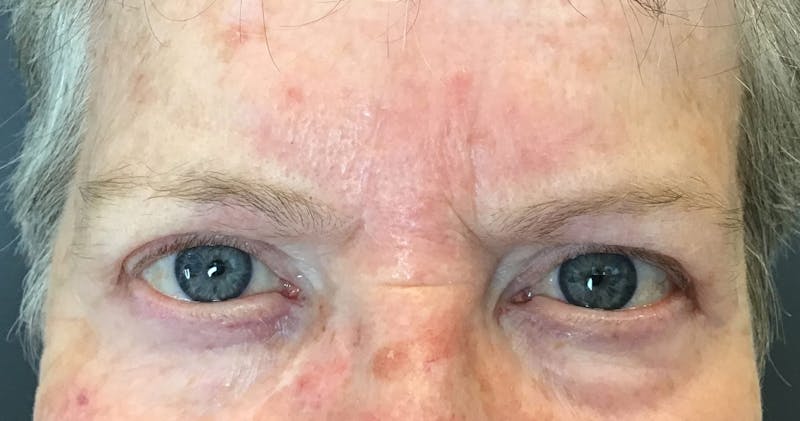 Botox Before & After Gallery - Patient 341737 - Image 2