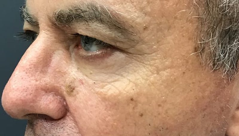 Blepharoplasty Before & After Gallery - Patient 380770 - Image 3