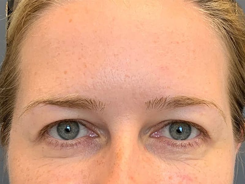 Botox Before & After Gallery - Patient 945116 - Image 5