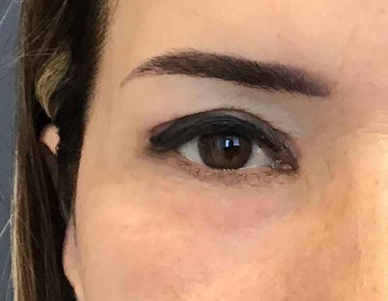 Blepharoplasty Before & After Gallery - Patient 368176 - Image 4