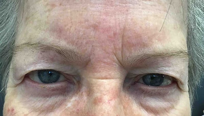 Blepharoplasty Before & After Gallery - Patient 288698 - Image 1