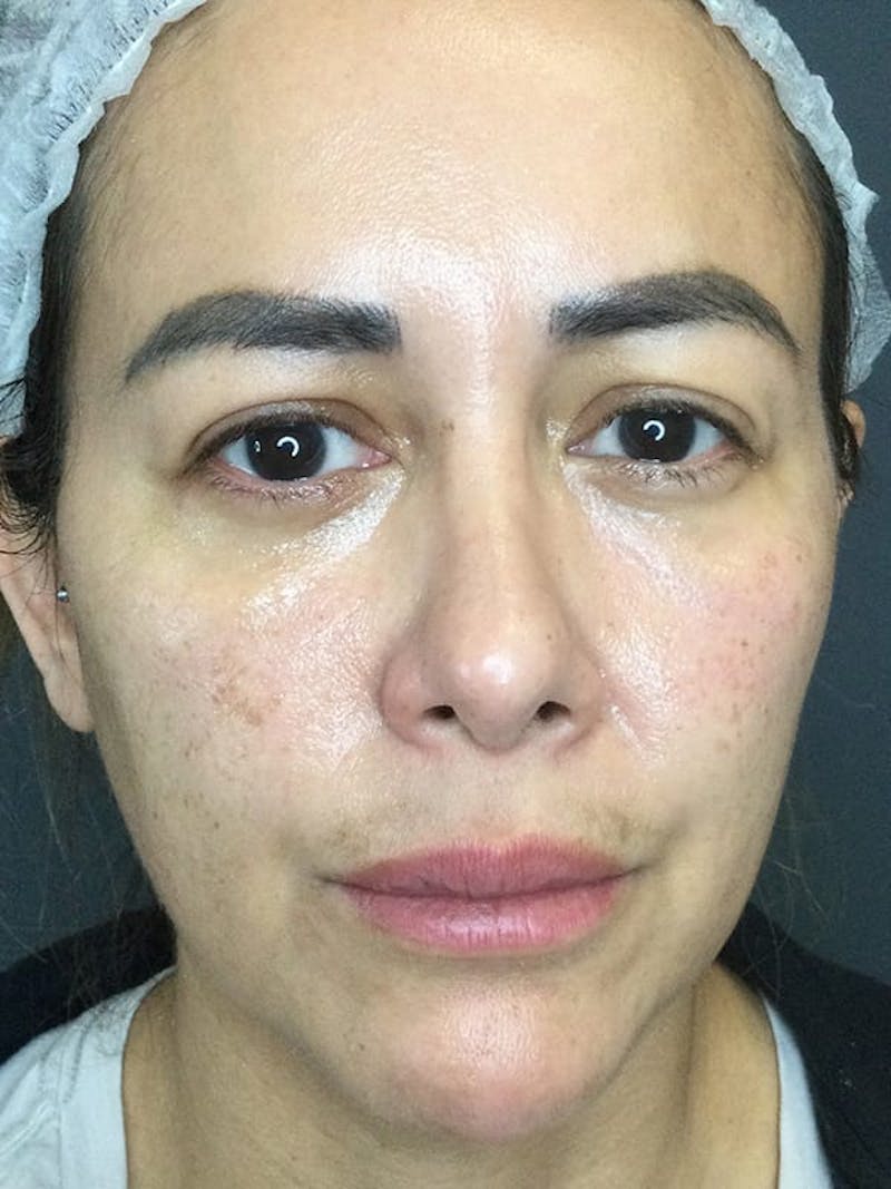 Dermal Fillers Before & After Gallery - Patient 976688 - Image 1