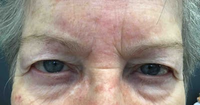 Botox Before & After Gallery - Patient 341737 - Image 1
