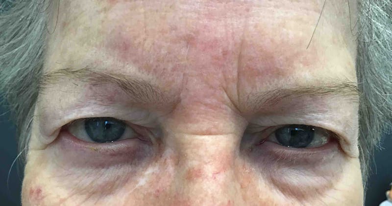 Botox Before & After Gallery - Patient 341737 - Image 1