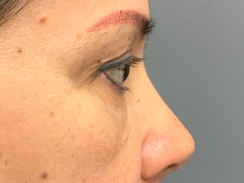 Blepharoplasty Before & After Gallery - Patient 341667 - Image 7