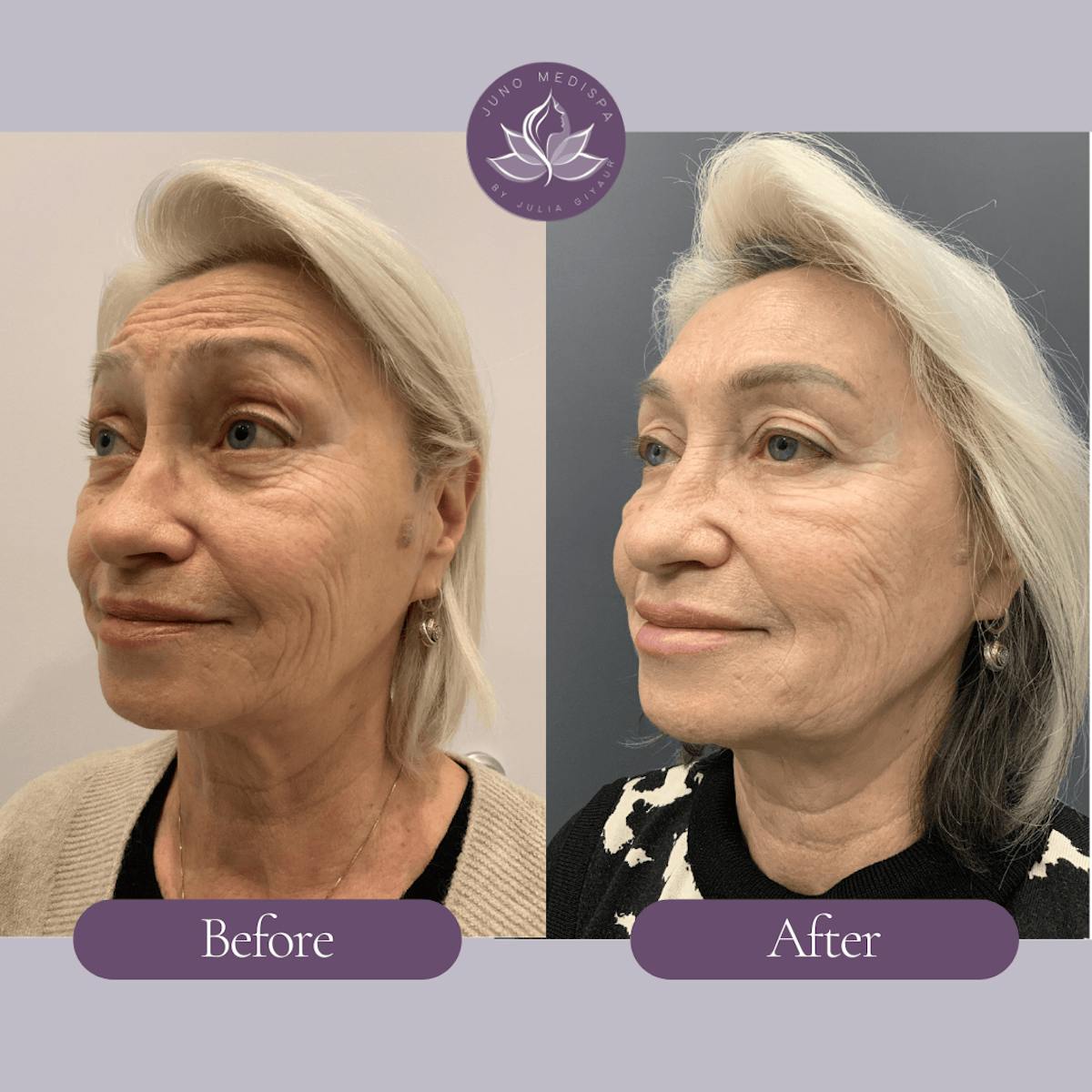 Botox Before & After Gallery - Patient 341932 - Image 3