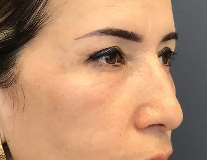 Blepharoplasty Before & After Gallery - Patient 368176 - Image 2