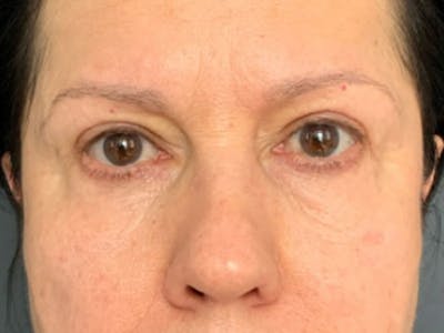 Blepharoplasty Before & After Gallery - Patient 289139 - Image 2