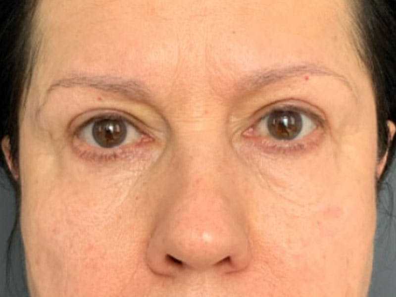 Blepharoplasty Before & After Gallery - Patient 289139 - Image 2