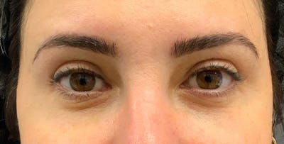 Blepharoplasty Before & After Gallery - Patient 156052 - Image 1